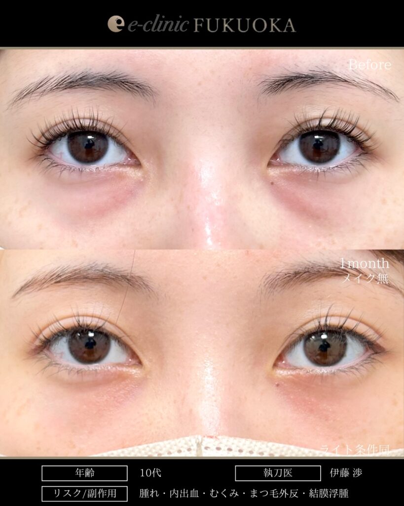 裏ハムラ法の症例写真 (103)