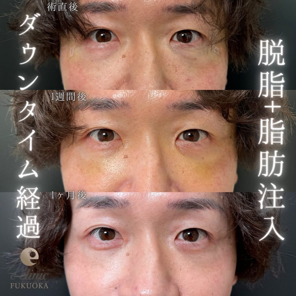 脱脂と脂肪注入の症例写真 (8)