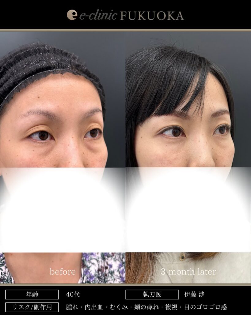 裏ハムラ法と埋没法の症例写真 (13)