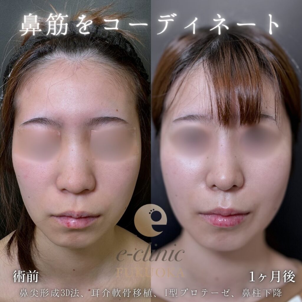 鼻尖形成と軟骨移植とプロテーゼと鼻柱下降の症例写真 (5)