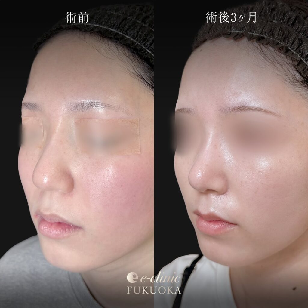 鼻尖形成と軟骨移植と鼻柱下降の症例写真 (4)