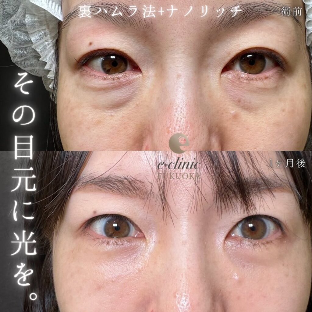 裏ハムラ法と脂肪注入の症例写真 (19)