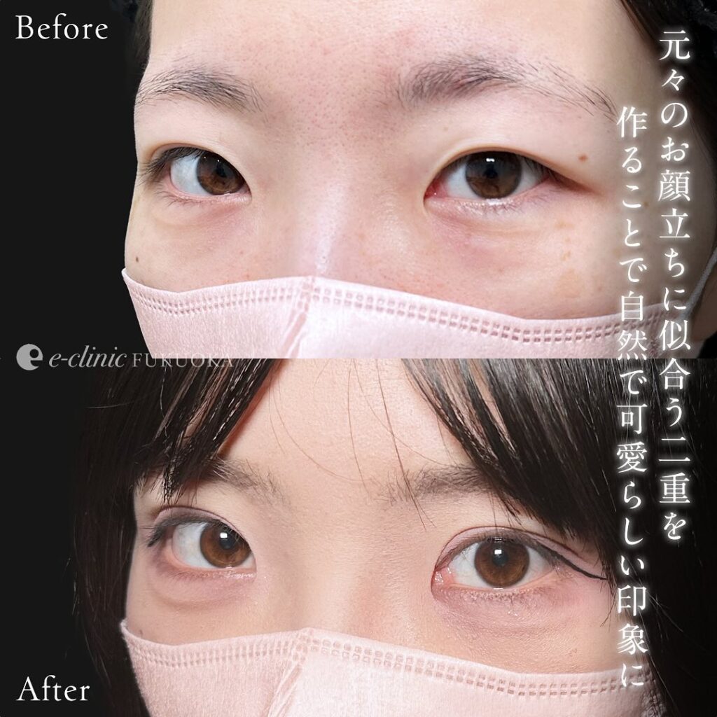 たるみ取り併用全切開の症例写真 (6)