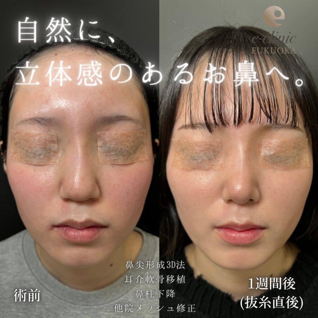 鼻尖形成と軟骨移植と鼻柱下降と他院修正の症例写真 (3)