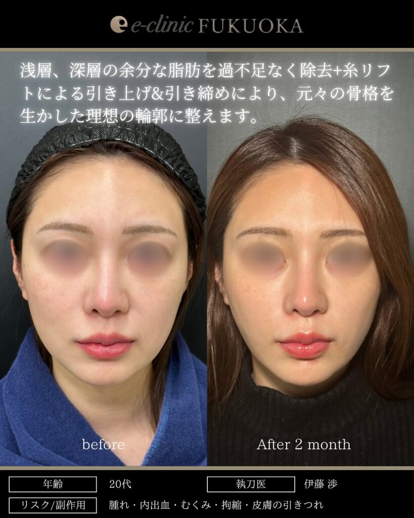 頬と顎下の脂肪吸引とジョールファットとバッカルファットと糸リフトの症例写真 (6)