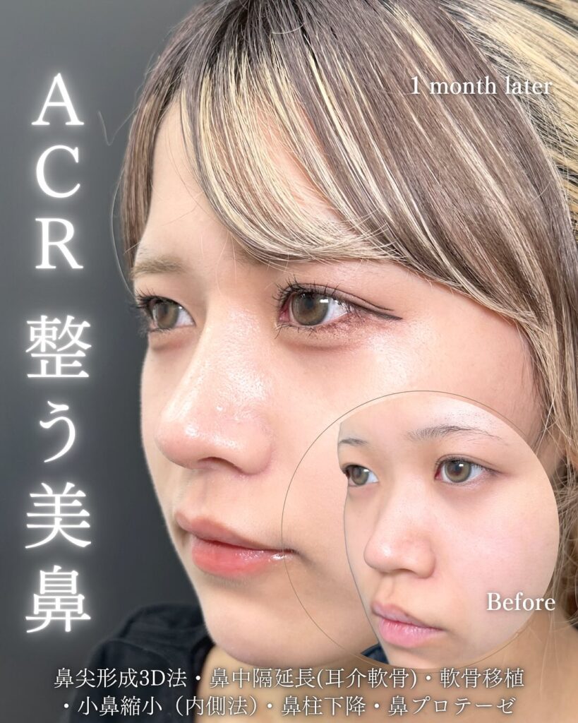鼻中隔延長と鼻尖形成と軟骨移植と小鼻縮小と鼻柱下降とプロテーゼの症例写真 (4)