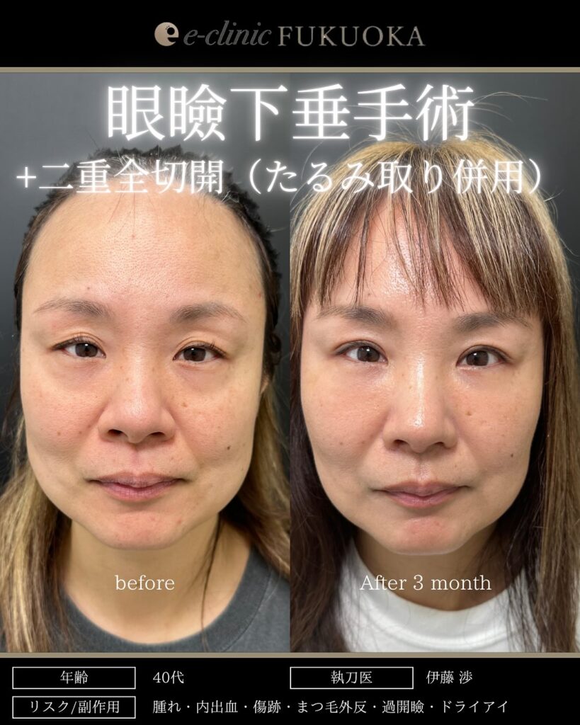 全切開と眼瞼下垂の症例写真 (1)