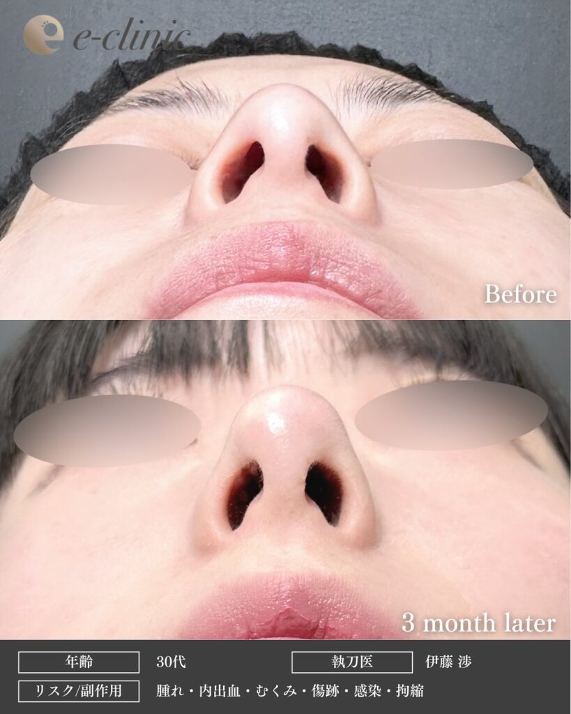 鼻尖形成+軟骨移植の症例写真 (2)