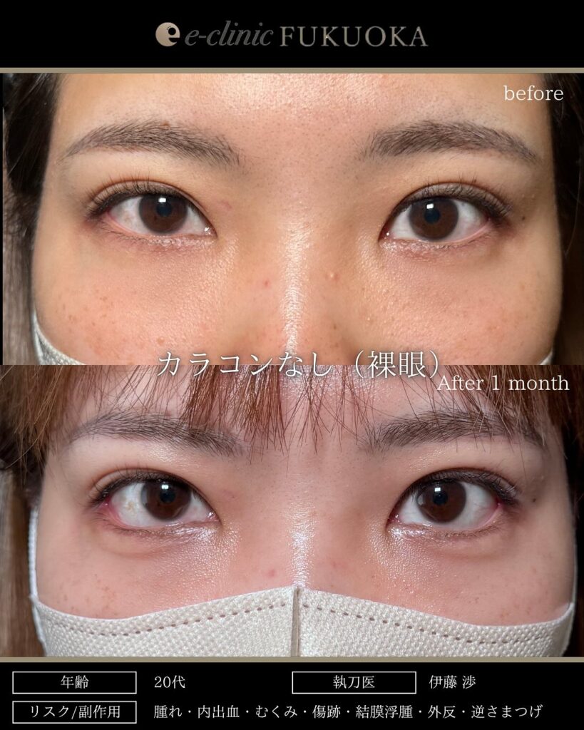 タレ目形成と目尻切開の症例写真 (15)