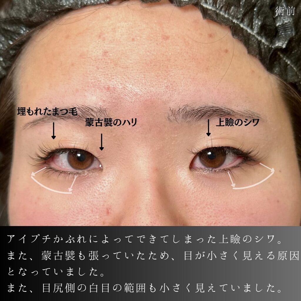 埋没法と目頭切開と目尻切開とタレ目形成の症例写真 (5)