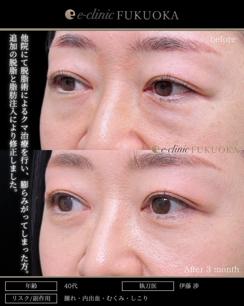 他院のクマ取り修正と脂肪注入と脱脂の症例写真 (4)