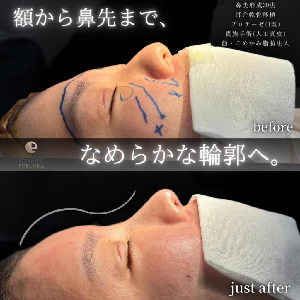 鼻尖形成と軟骨移植とプロテーゼと額とこめかみの脂肪注入と人工真皮の症例写真 (2)