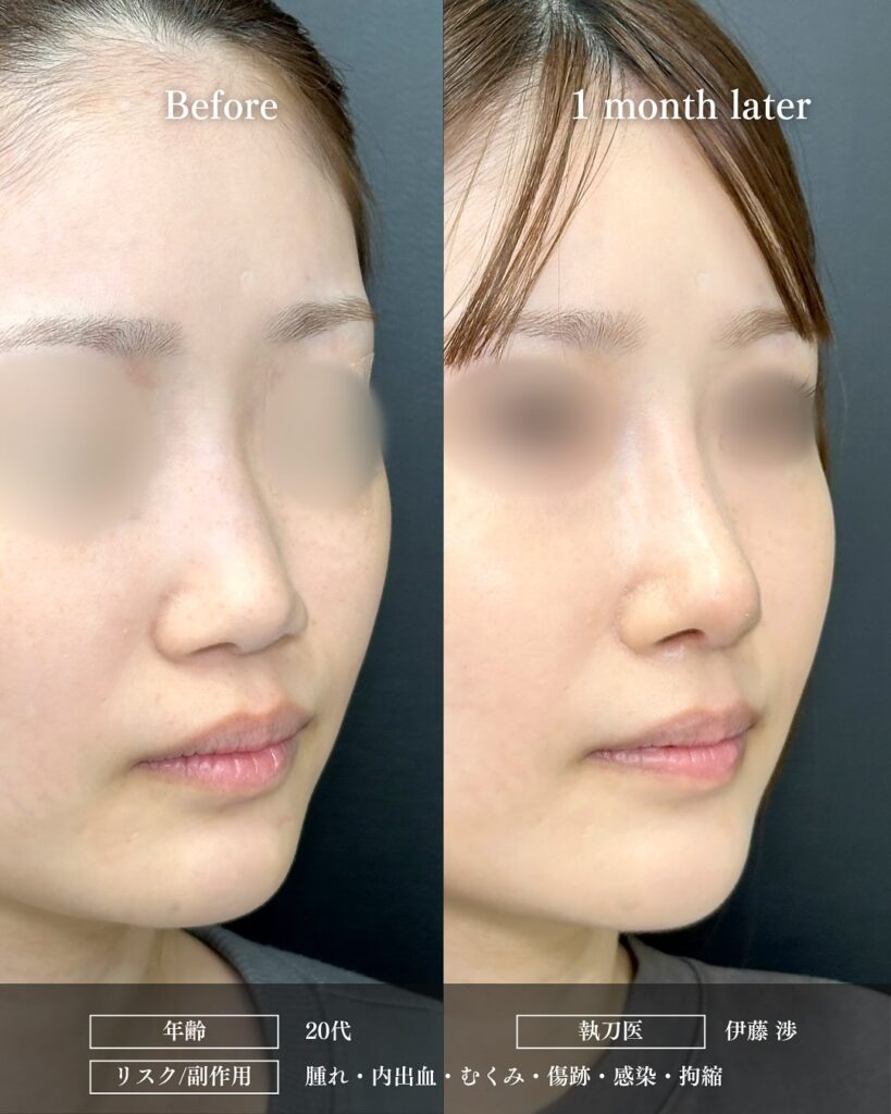 鼻中隔延長と鼻尖形成と軟骨移植とプロテーゼの症例写真 (3)