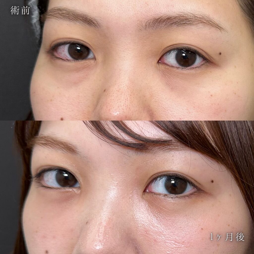 裏ハムラ法の症例写真 (42)