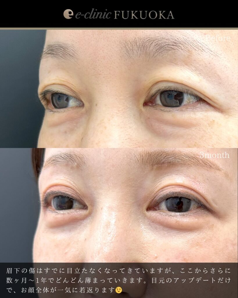 眉下切開と裏ハムラ法の症例写真 (2)