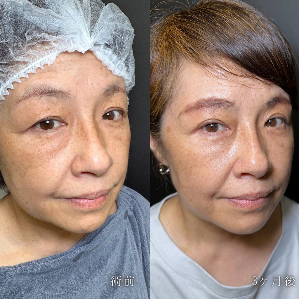 裏ハムラ法と脂肪注入と眉下切開の症例写真 (3)