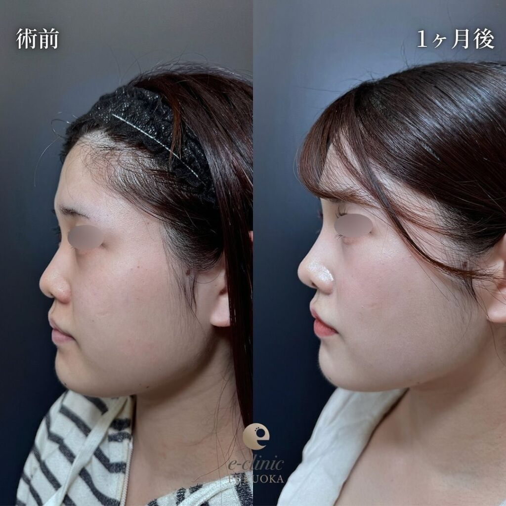 顔の脂肪吸引と糸リフトとバッカルファットの症例写真 (3)