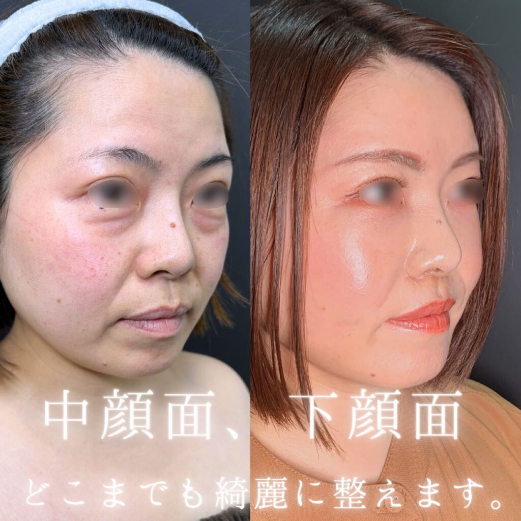 裏ハムラ方と脂肪注入と人中短縮 の症例写真 (2)
