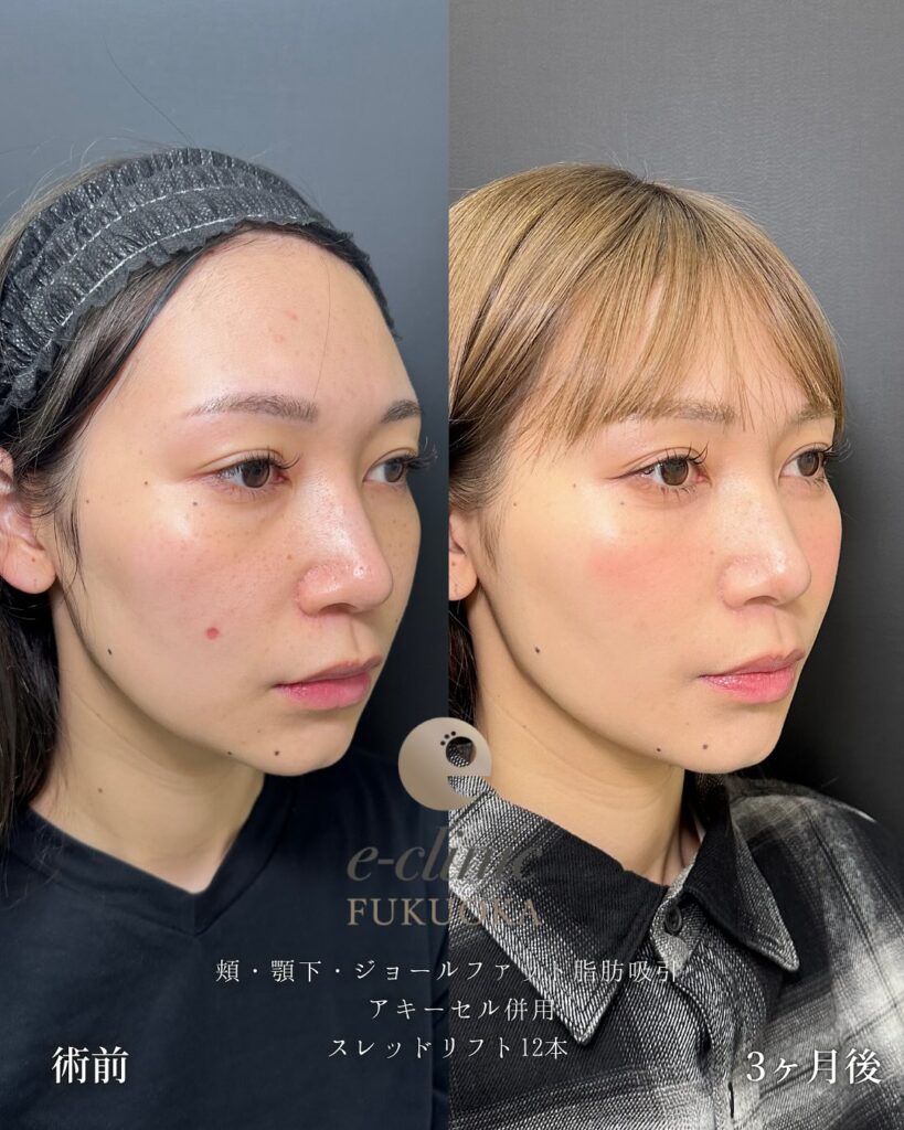 頬と顎下の脂肪吸引とジョールファットと糸リフトの症例写真 (4)