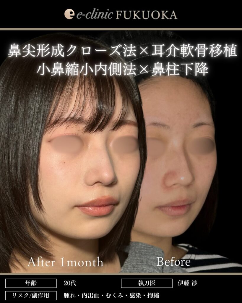 鼻尖形成と耳介軟骨移植と小鼻縮小と鼻柱下降の症例写真 (1)
