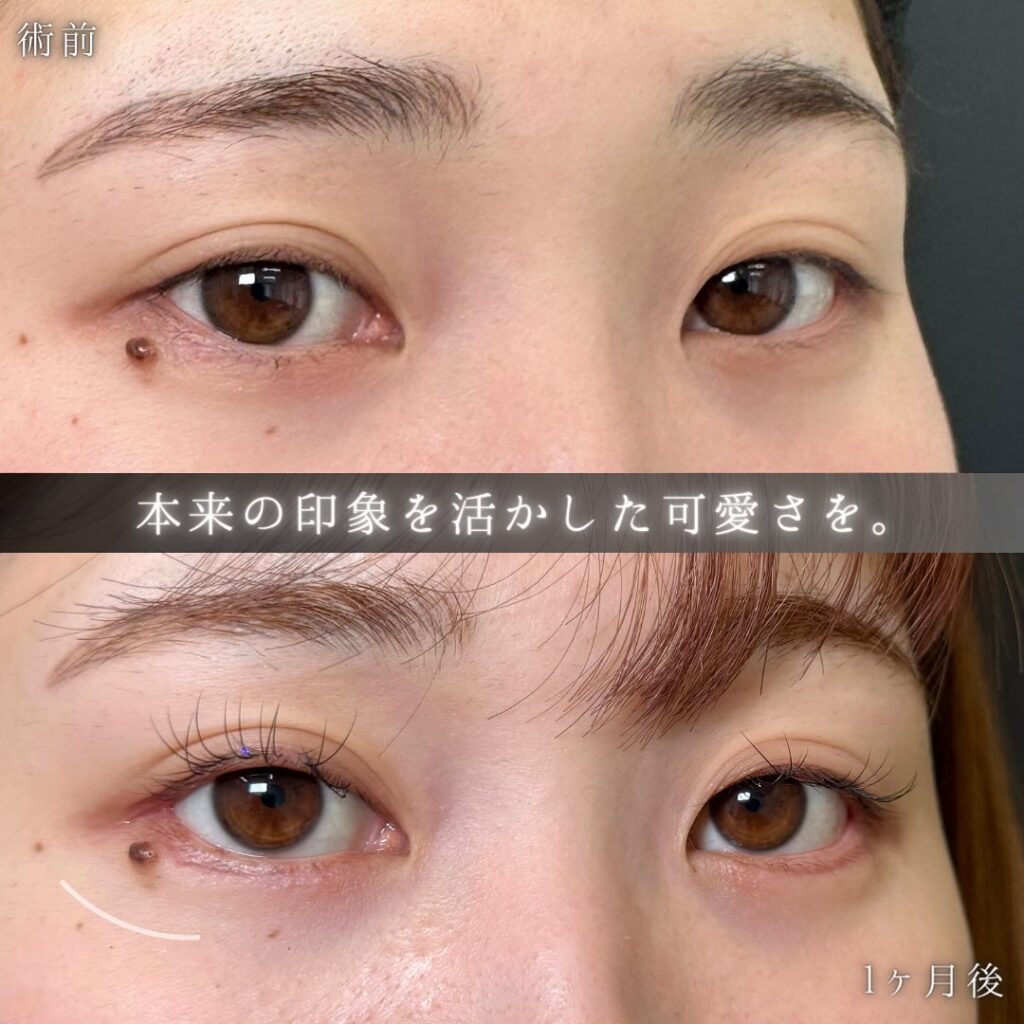 タレ目形成と目尻切開の症例写真 (3)