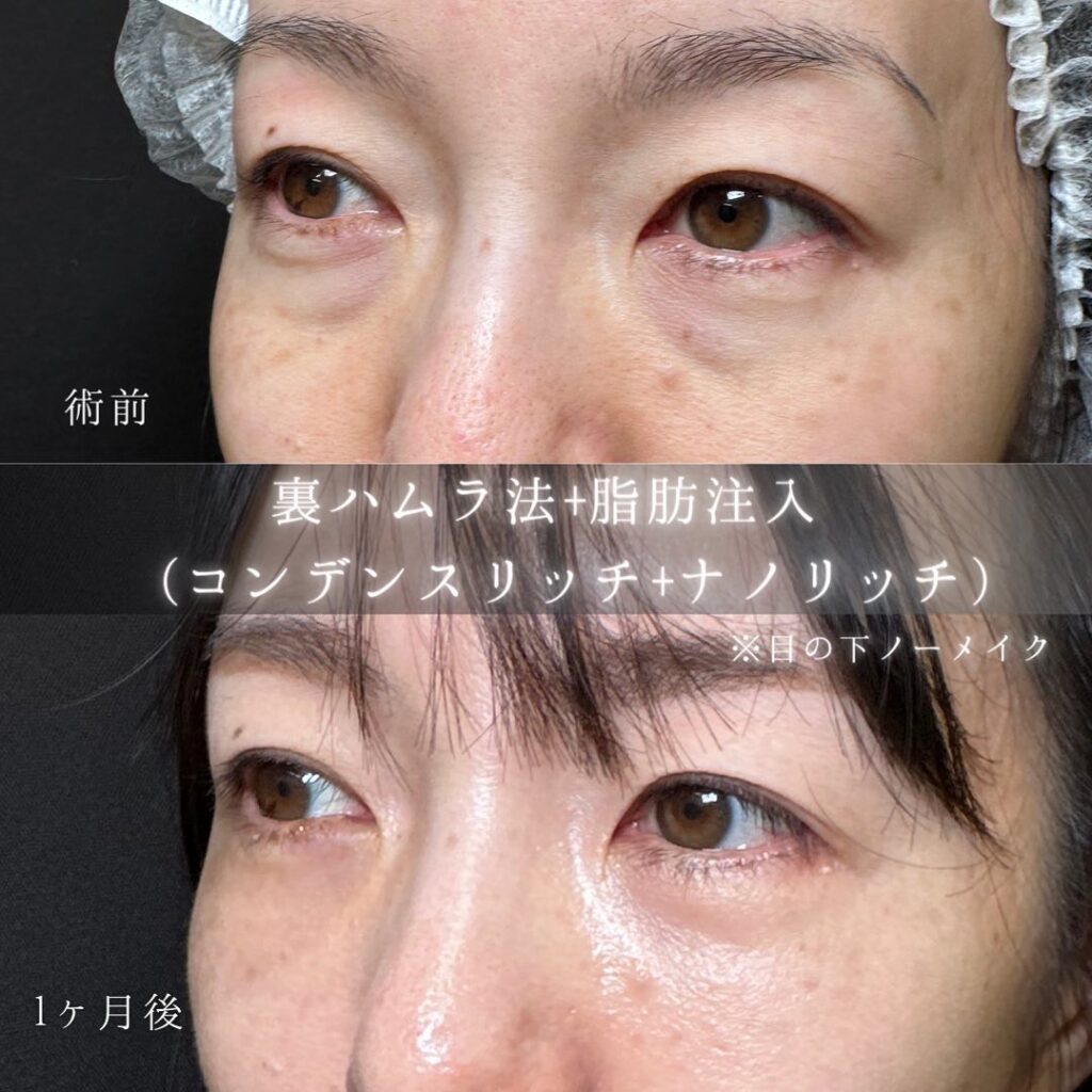 裏ハムラ法と脂肪注入の症例写真 (5)