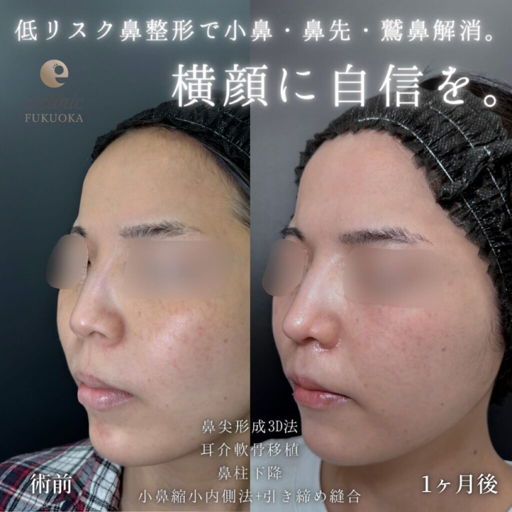 鼻尖形成と軟骨移植と鼻柱下降と小鼻縮小の症例写真 (1)