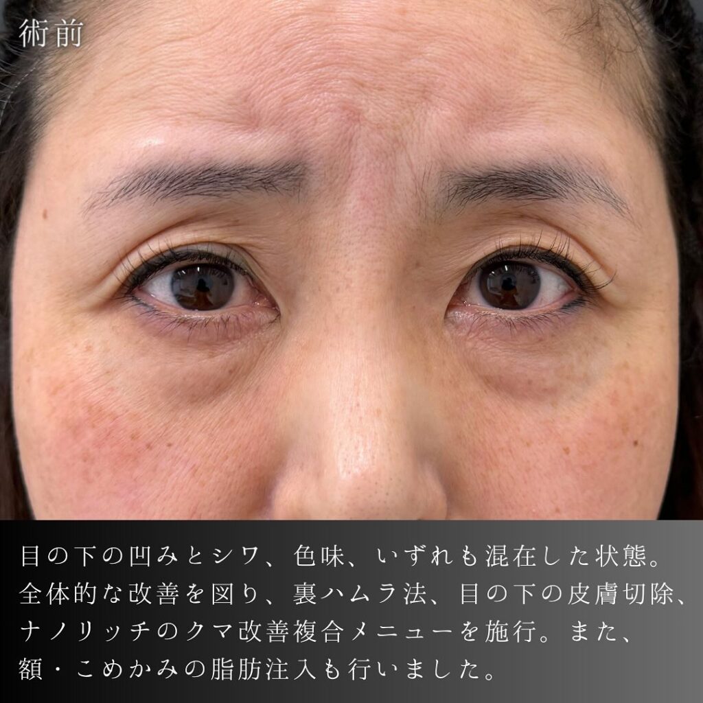 裏ハムラ法と目の下の脂肪注入と額とこめかみの脂肪注入の症例写真 (5)
