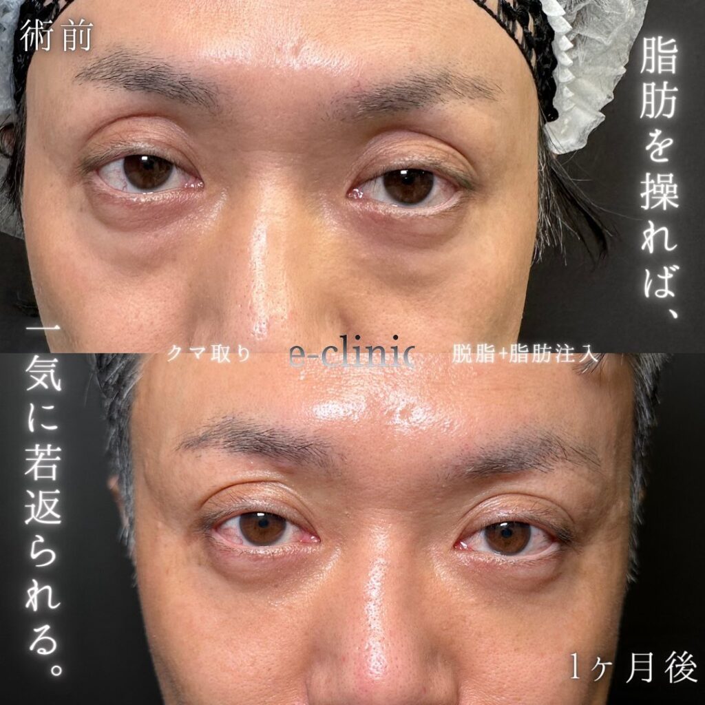 脱脂と脂肪注入の症例写真 (3)