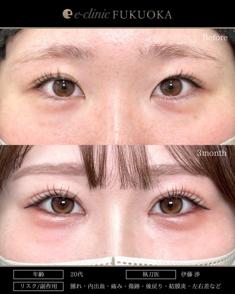 埋没法と目頭切開の症例写真 (10)