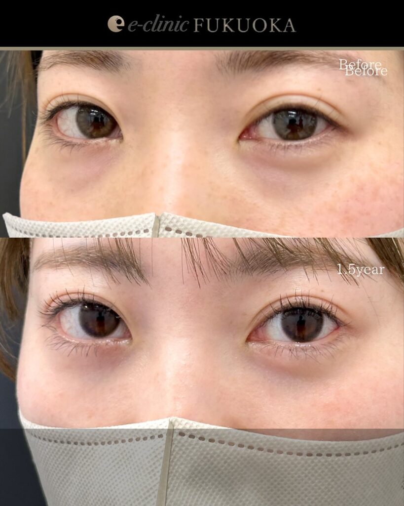 裏ハムラ法の症例写真 (96)