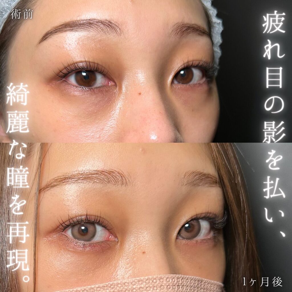 裏ハムラ法と涙袋と目の下のヒアルロン酸の症例写真 (1)