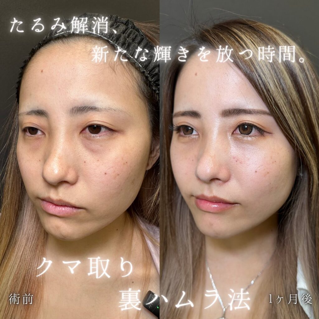 裏ハムラ法の症例写真 (33)