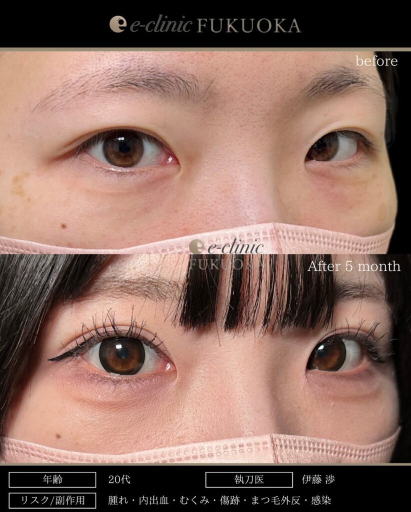 全切開の症例写真 (5)