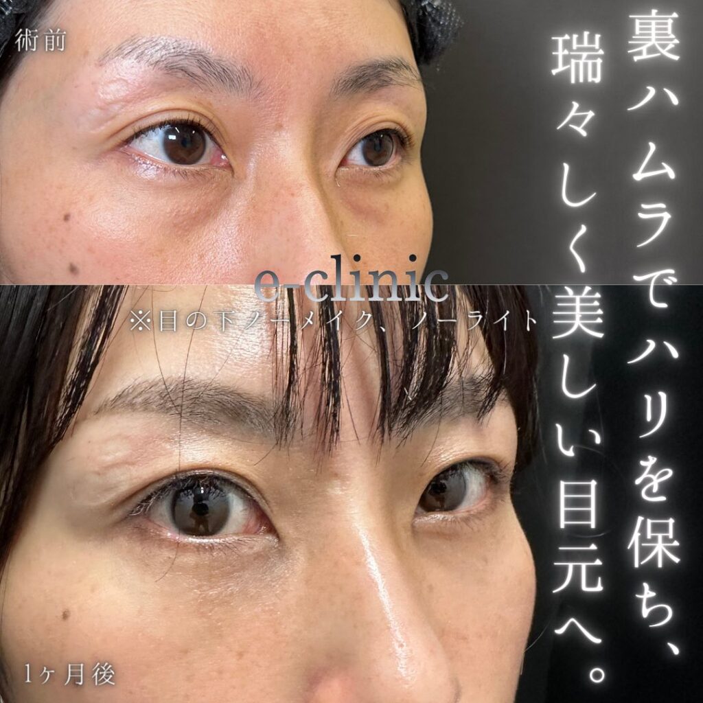 裏ハムラ法の症例写真 (54)