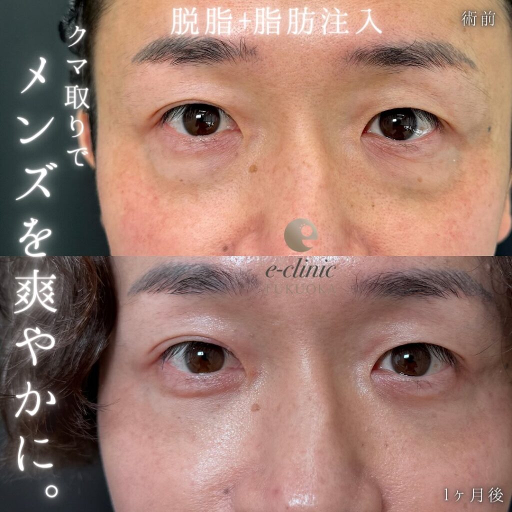 脱脂と脂肪注入の症例写真 (7)