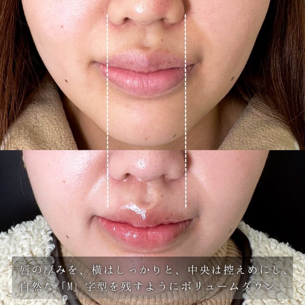唇縮小の症例写真 (4)