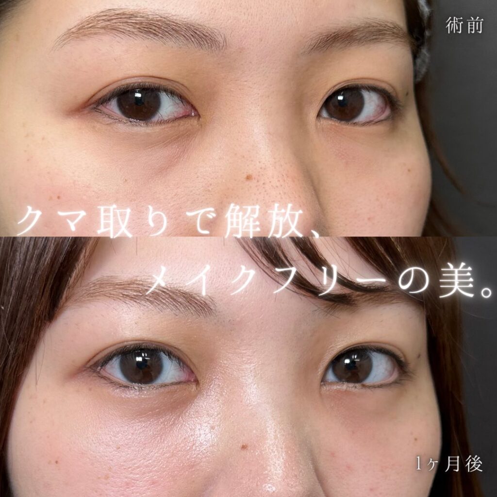 裏ハムラ法の症例写真 (41)