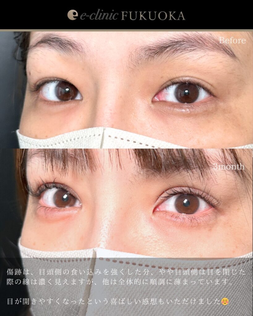 たるみとり併用全切開と眼瞼下垂と涙袋のヒアルロン酸の症例写真 (3)