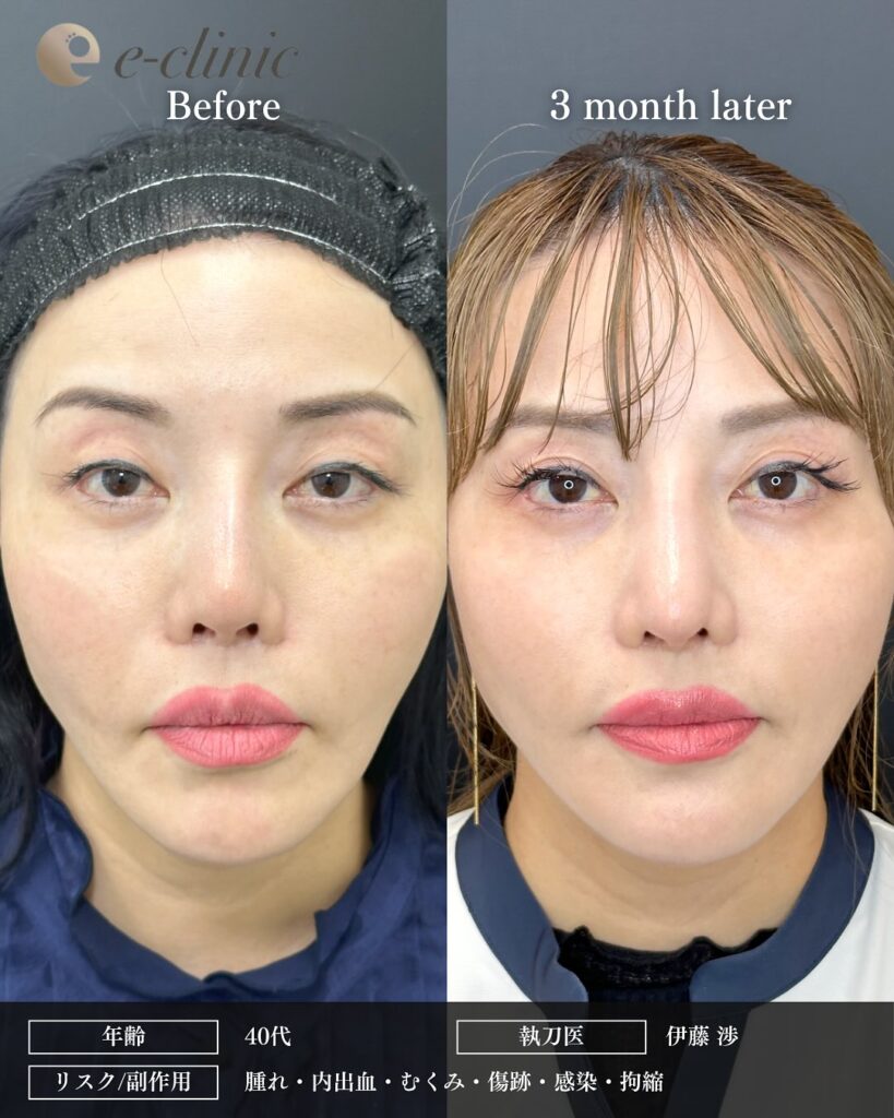 鼻尖形成と軟骨移植とプロテーゼ入れ替えの症例写真 (5)