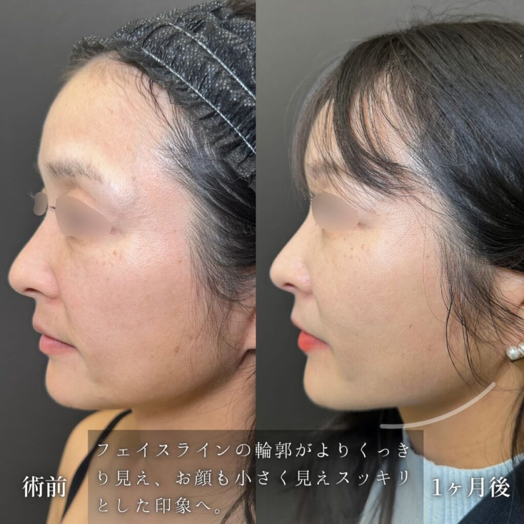 ハイブリットフェイスリフトと裏ハムラ法の症例写真 (2)