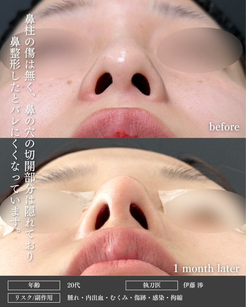 鼻尖形成と軟骨移植の症例写真 (41)