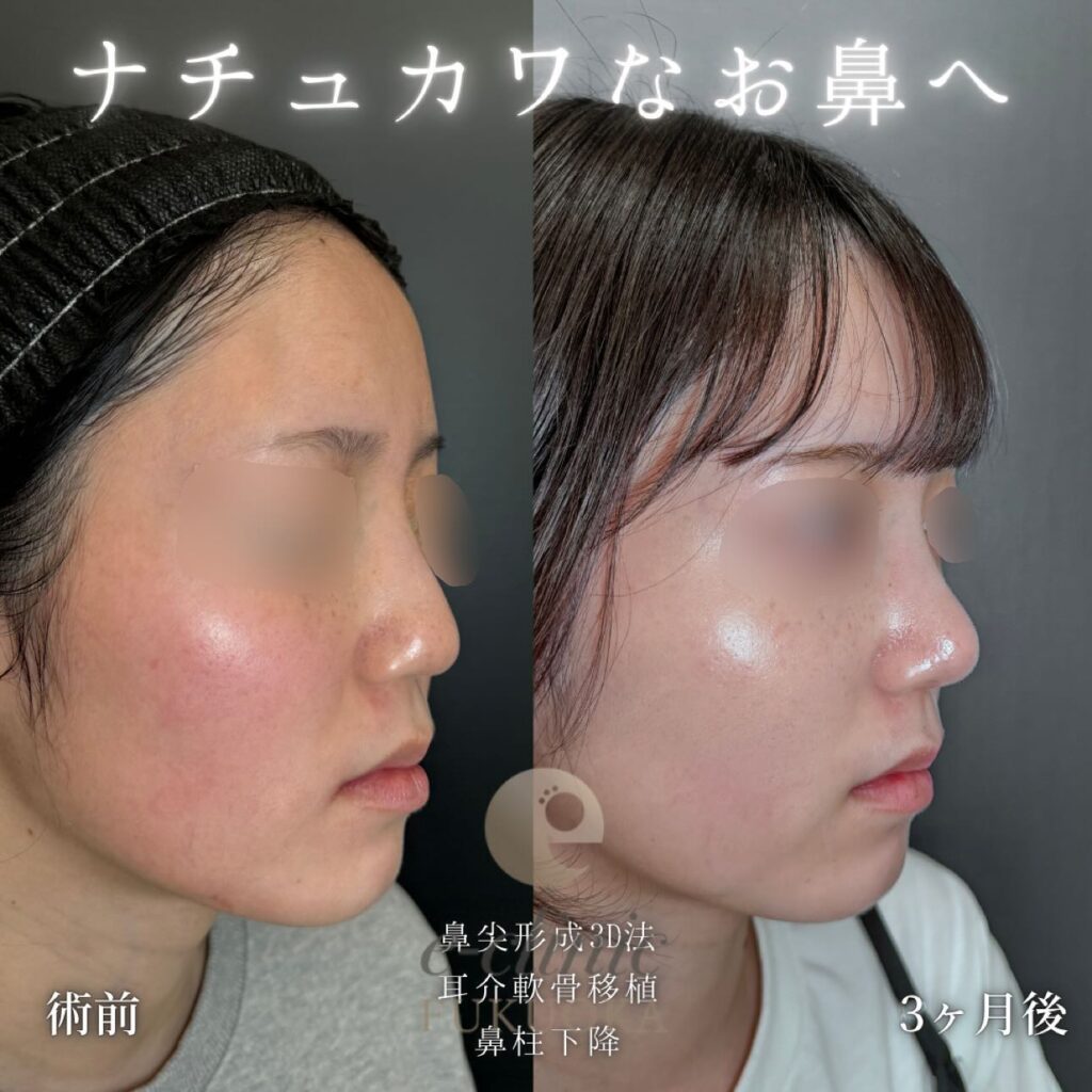 鼻尖形成と耳介軟骨移植と鼻柱下降の症例写真 (2)