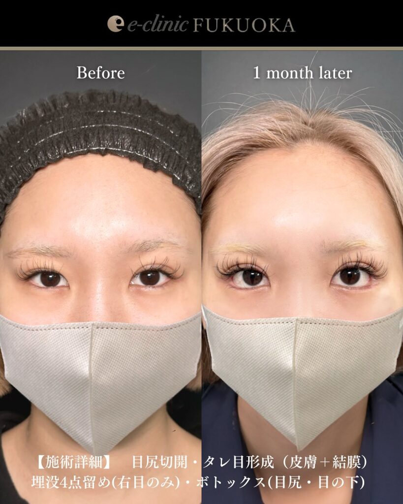 タレ目形成と目尻切開と埋没法の症例写真 (4)