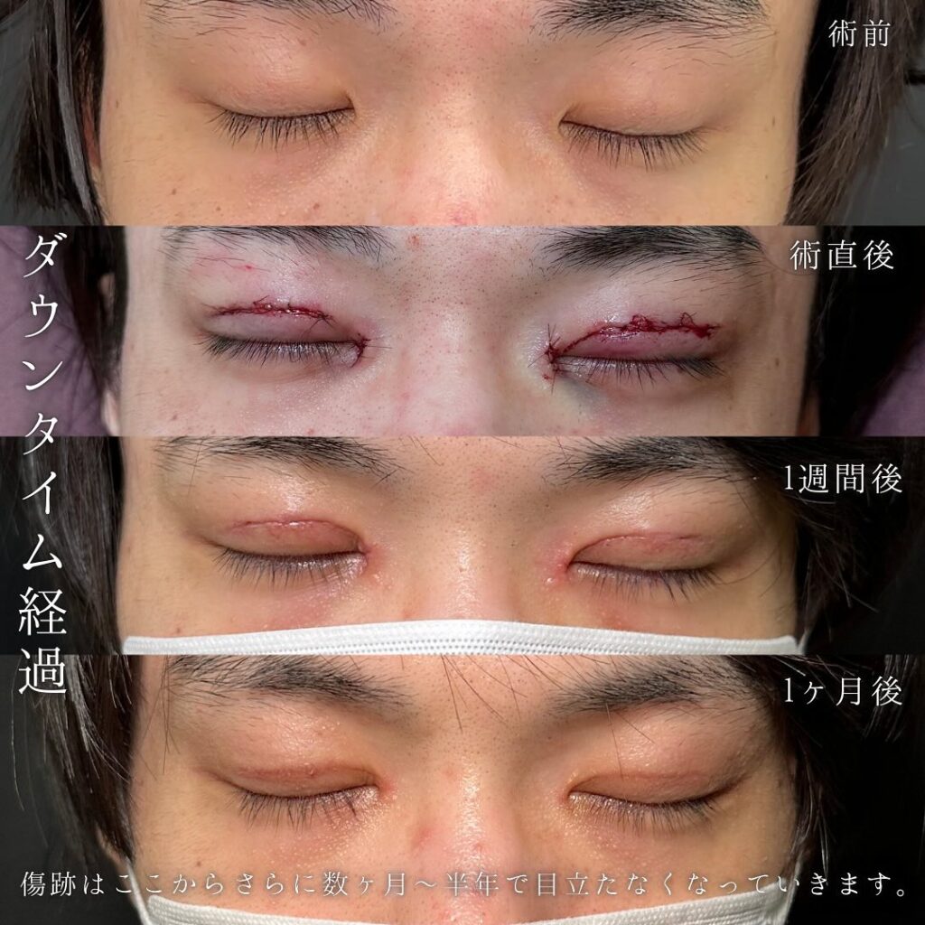 たるみ取り併用全切開と目頭切開の症例写真 (2)