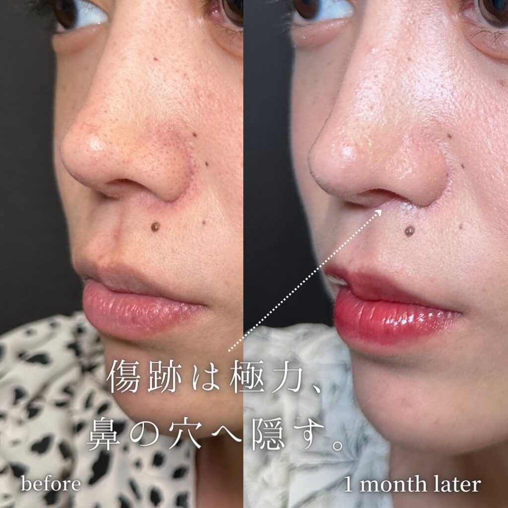 人中短縮の症例写真 (2)