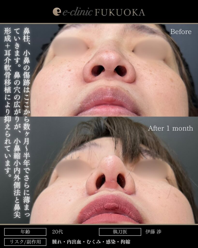 鼻尖形成と耳介軟骨移植と鼻柱下降とプロテーゼと小鼻縮小の症例写真 (2)