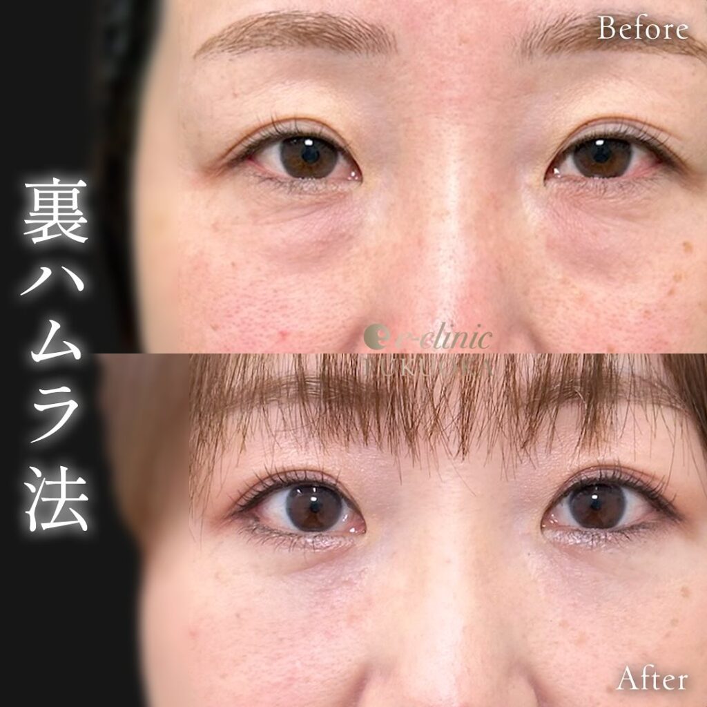 裏ハムラ法の症例写真 (88)