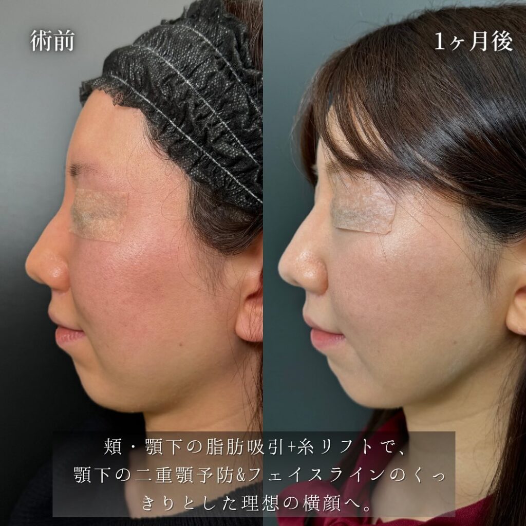 頬と顎下の脂肪吸引とジョールとメーラーファットと脂肪注入と糸リフトの症例写真 (1)