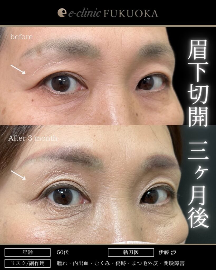 眉下切開の症例写真 (8)